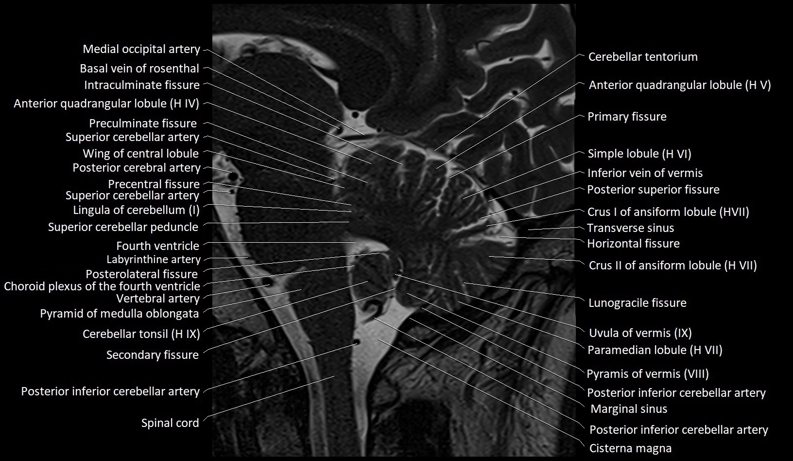 MRI Cerebellar anatomy sagittal High-resolution labelled image 26.webp